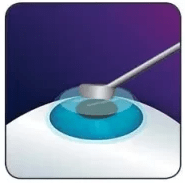 مرحله دوم عمل لازک